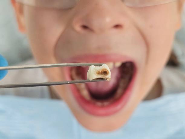 Best Emergency Tooth Extraction in New Boston, TX