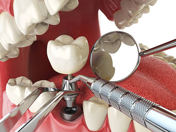 Best Emergency Root Canal Treatment in New Boston, TX